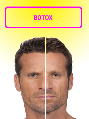 Botox trattamento delle rughe d'espressione